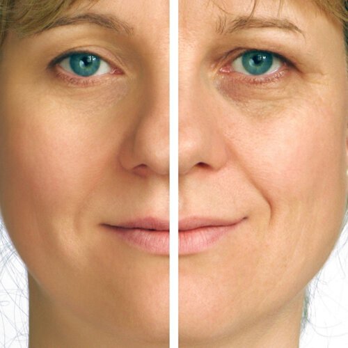A chronic tired look is a common sign of aging that can be corrected with plastic surgery.
