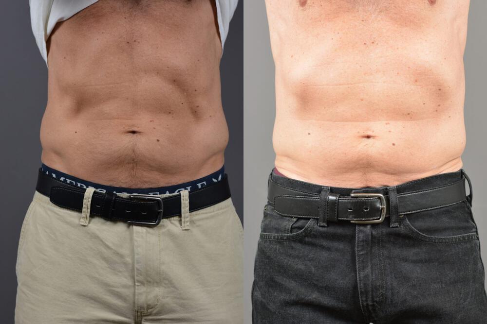 Sculpsure Before & After Image