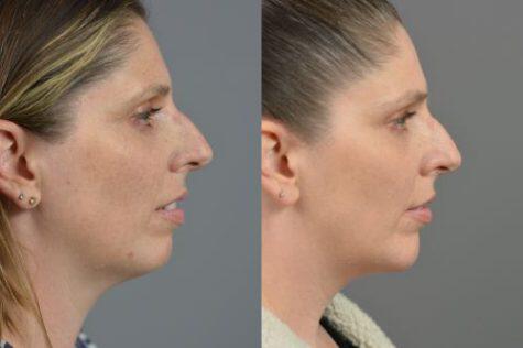 Chin Implant Before & After Image