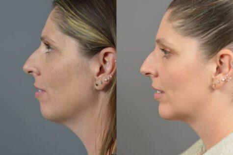 Liposuction Face Before & After Image