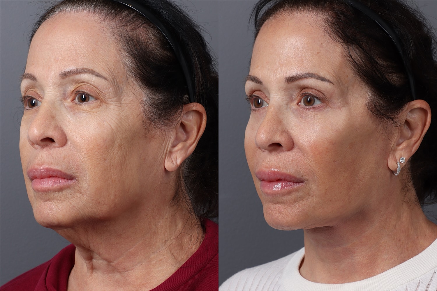 Before and after cosmetic treatments on a woman's face.