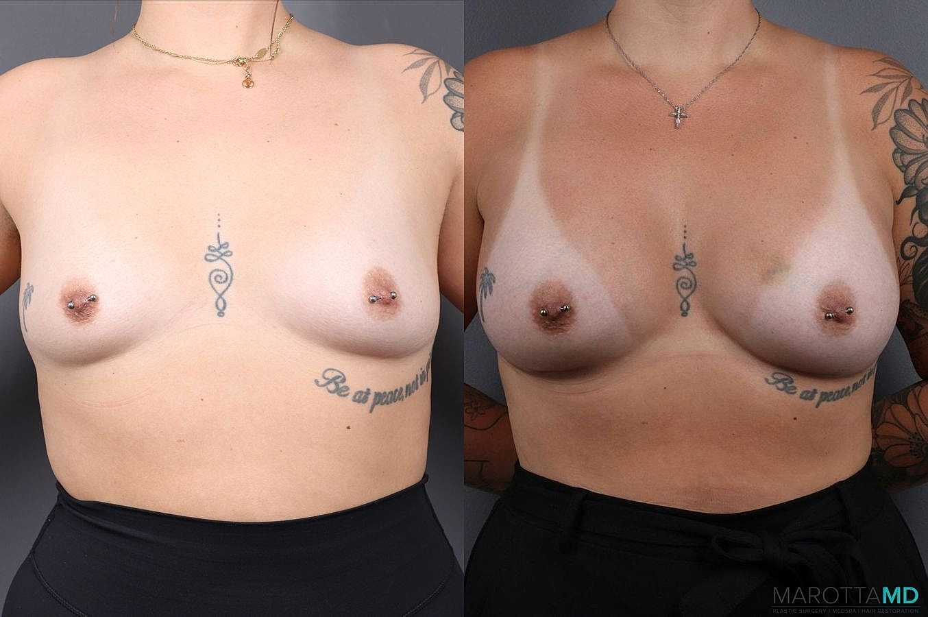 Breast Augmentation Before & After