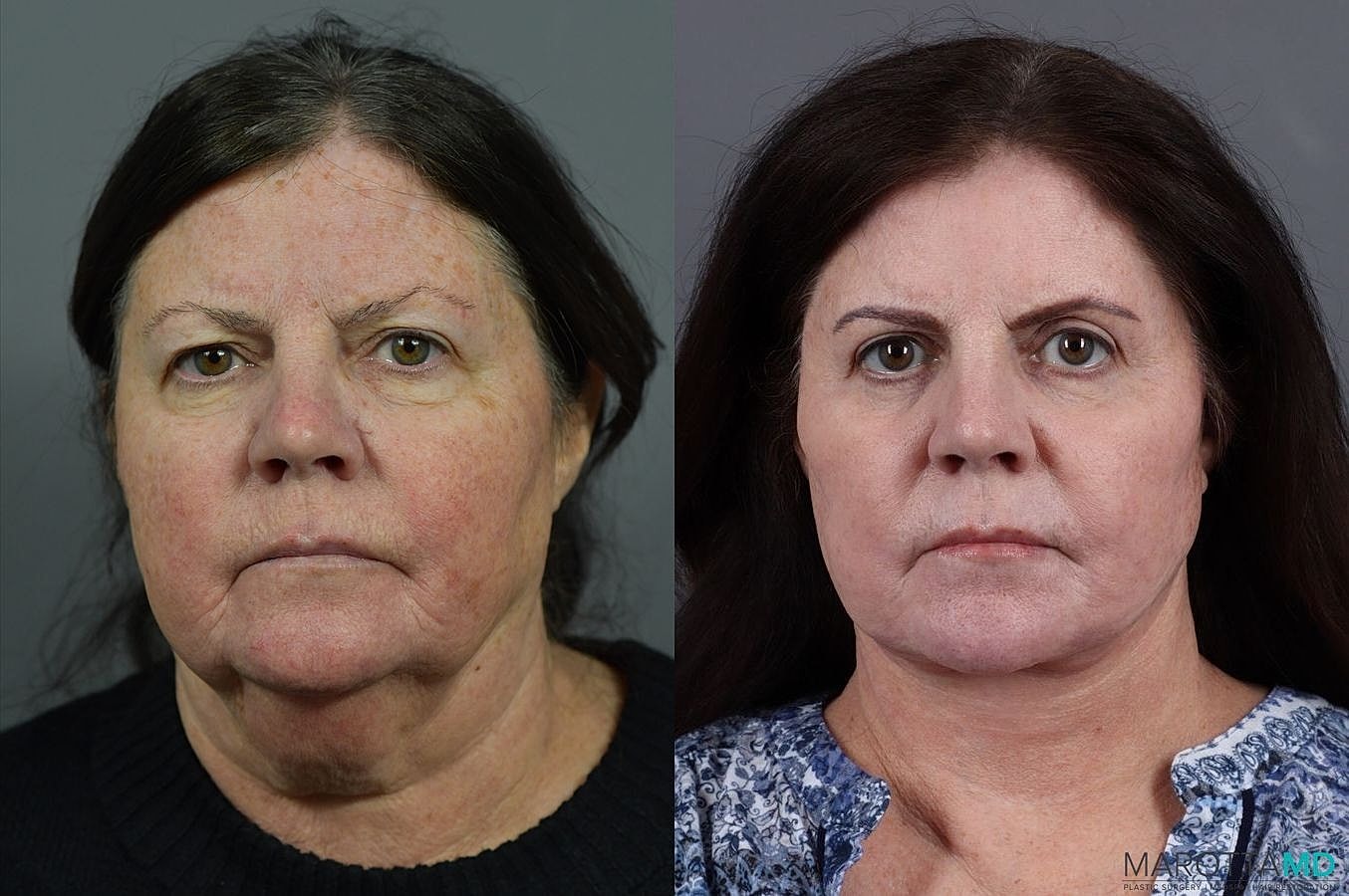 Laser Skin Resurfacing Before & After