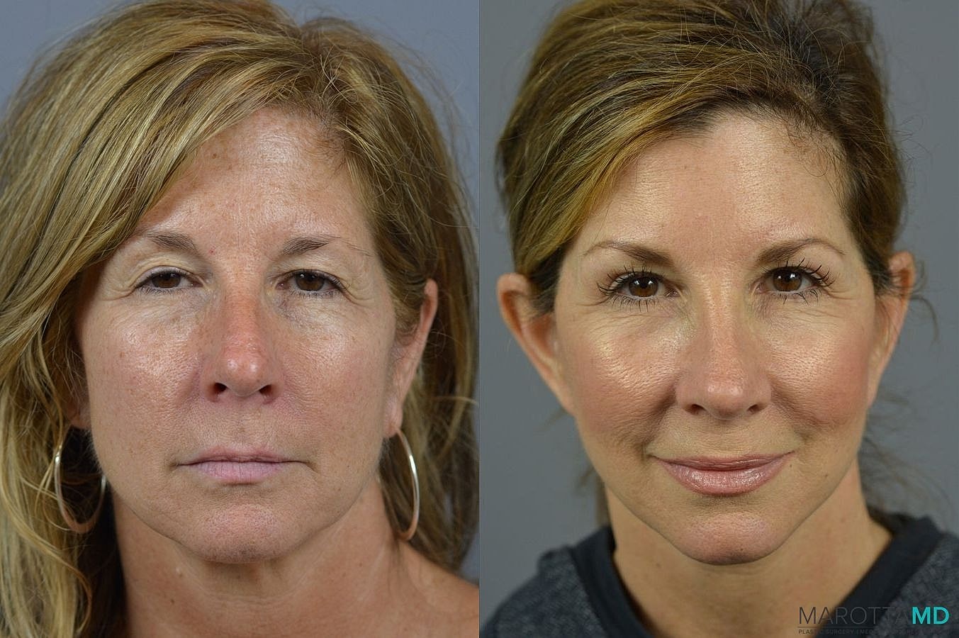 Laser Skin Resurfacing Before & After