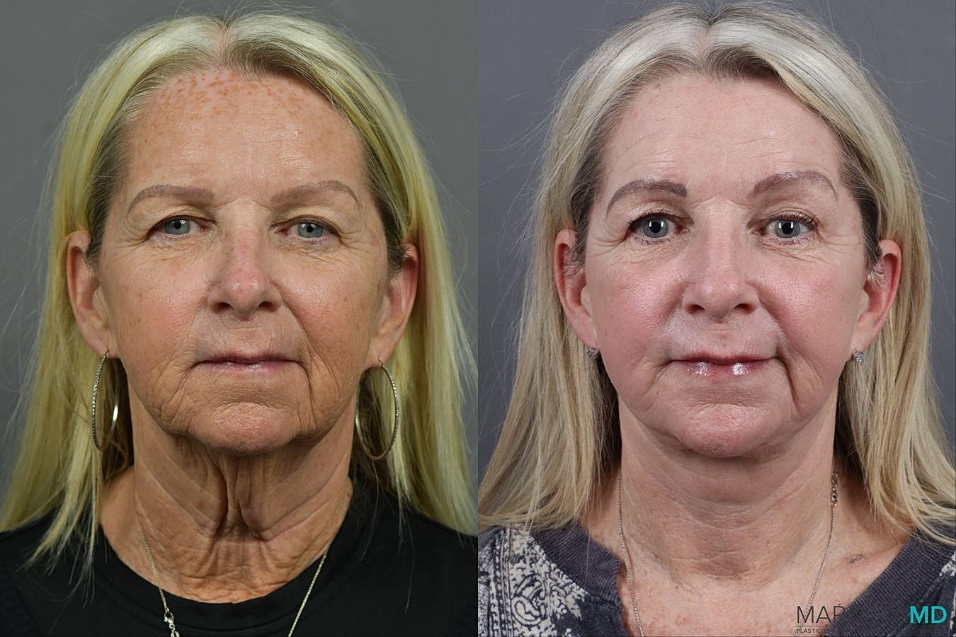 Laser Skin Resurfacing Before & After