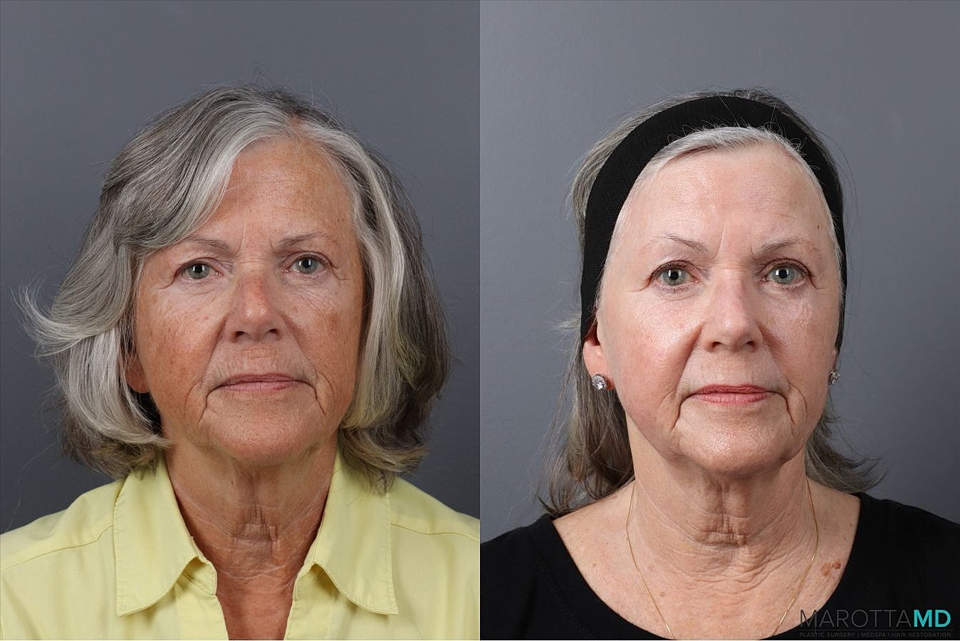Laser Skin Resurfacing Before & After