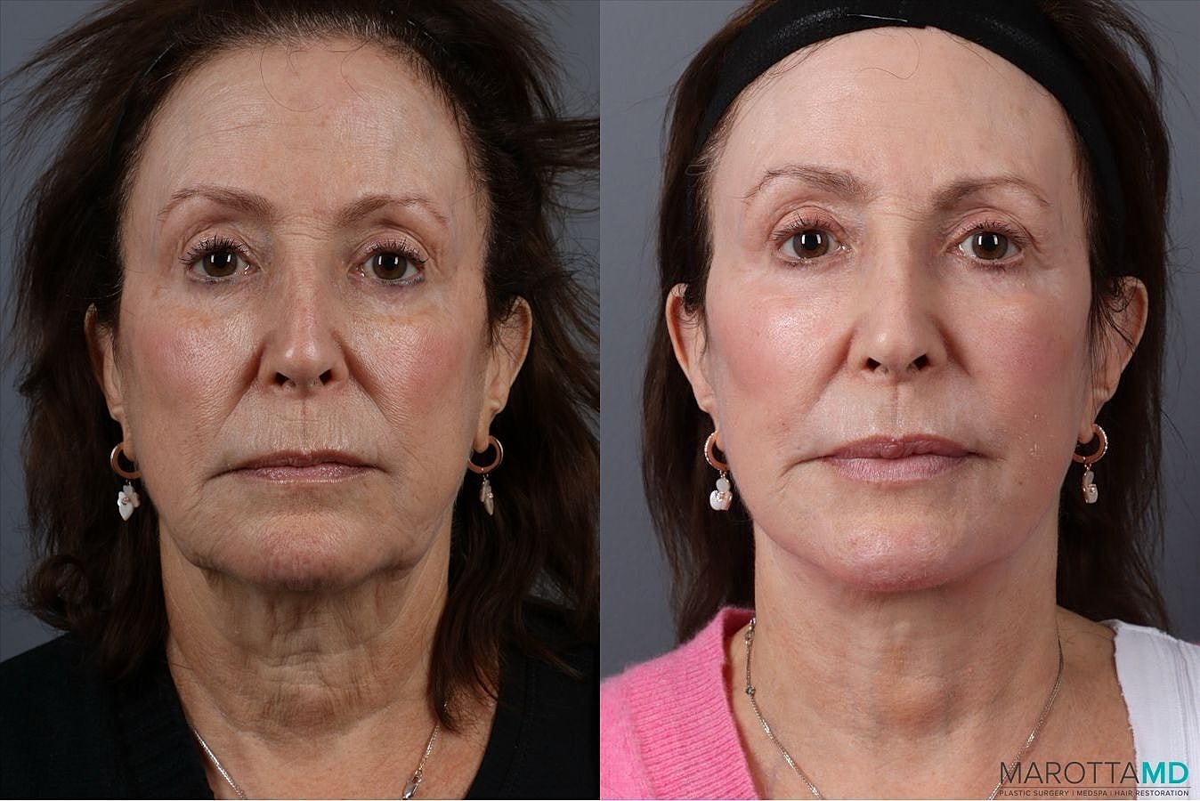 Laser Skin Resurfacing Before & After