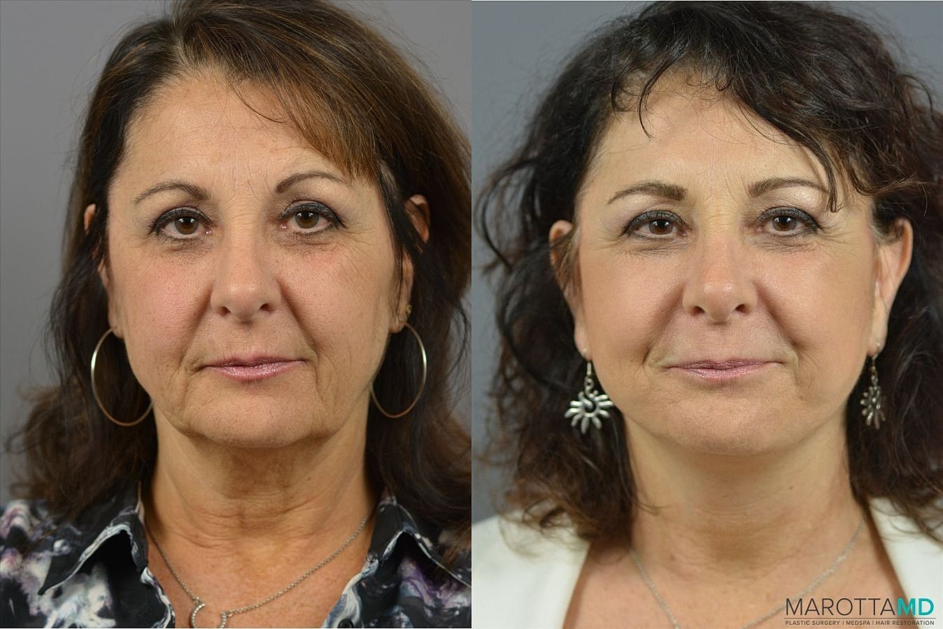 Laser Skin Resurfacing Before & After