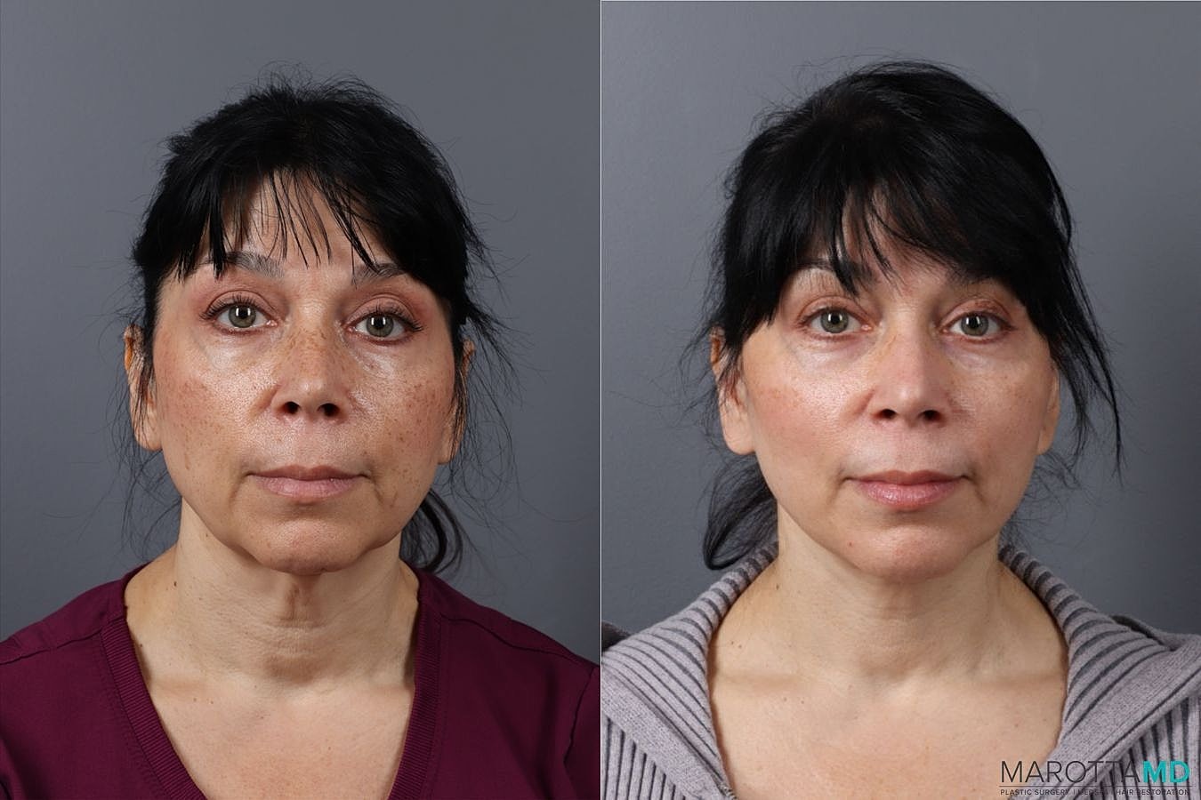 Laser Skin Resurfacing Before & After