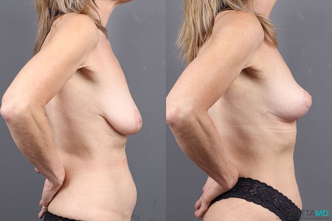 Breast Lift Before & After