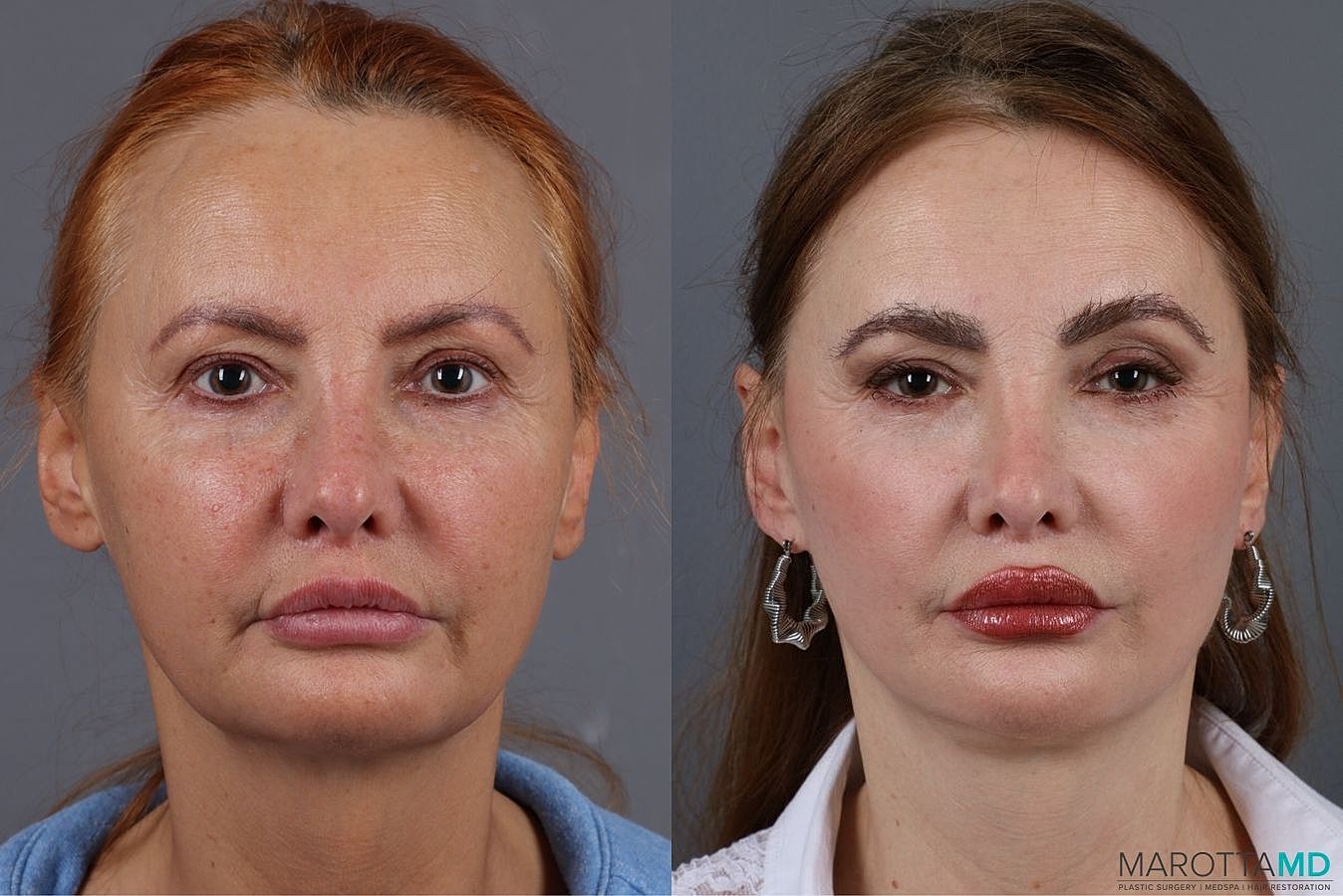 Mini Facelift Before & After