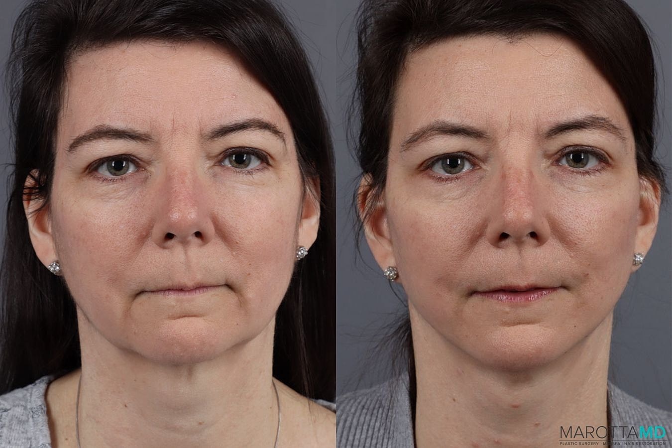 Mini Facelift Before & After