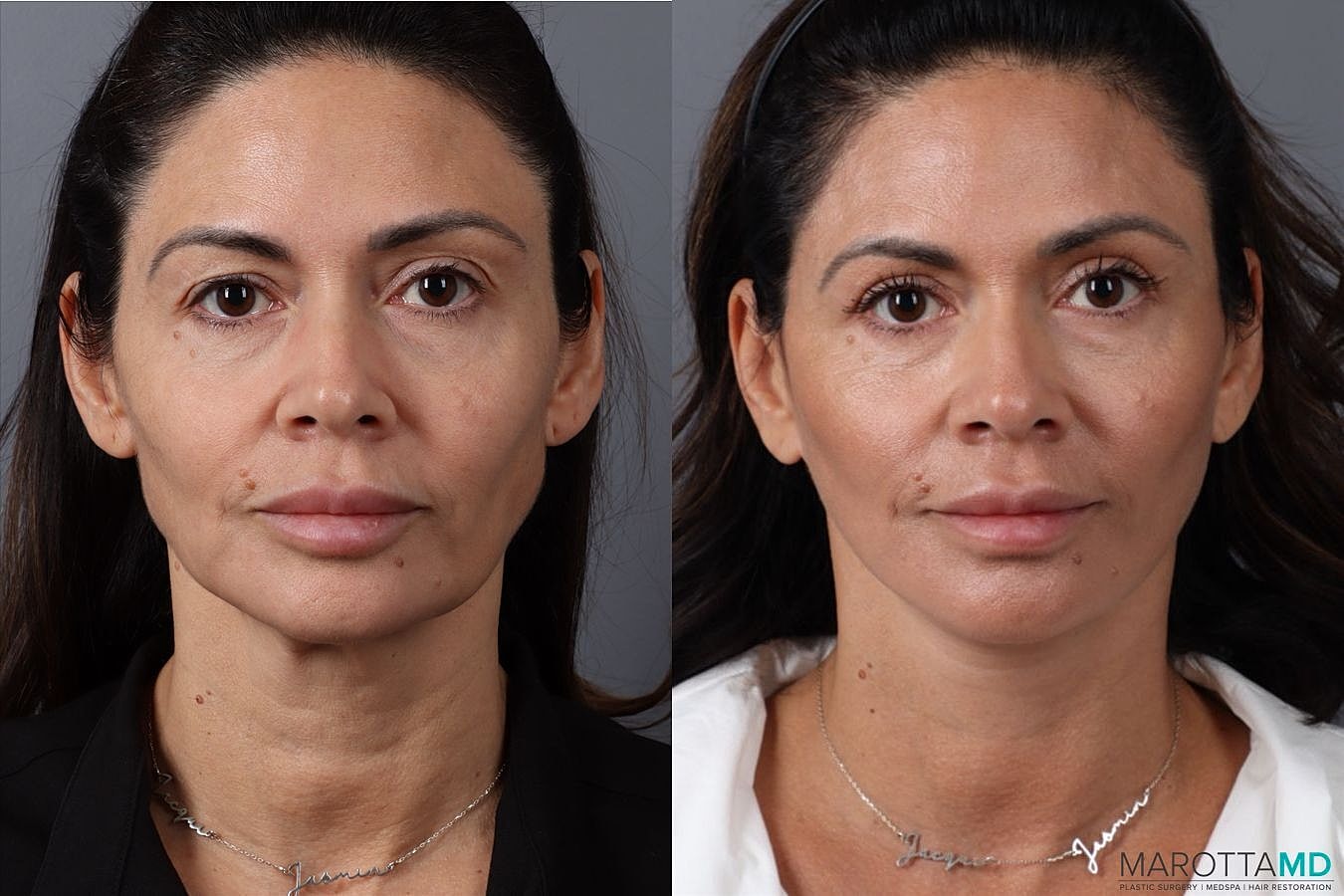 Mini Facelift Before & After