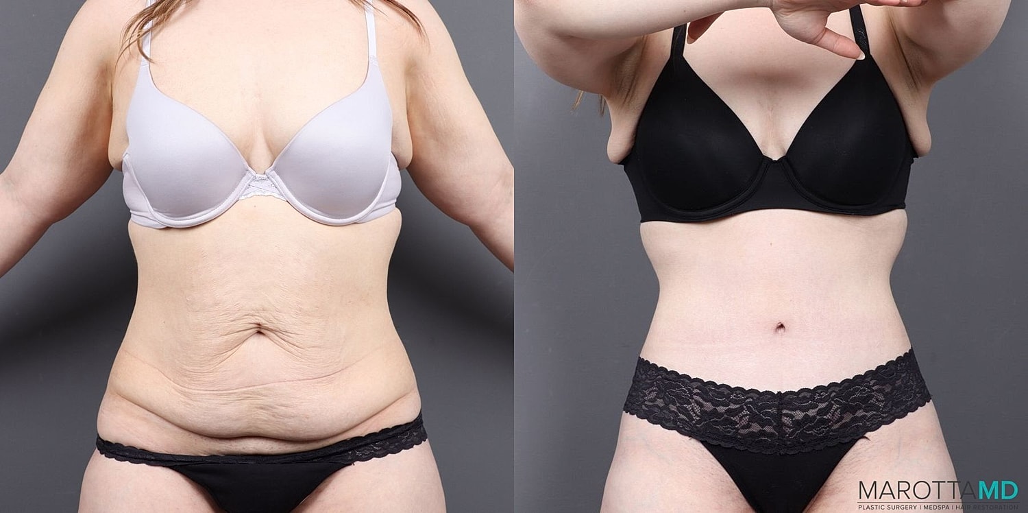 Abdominoplasty Before & After