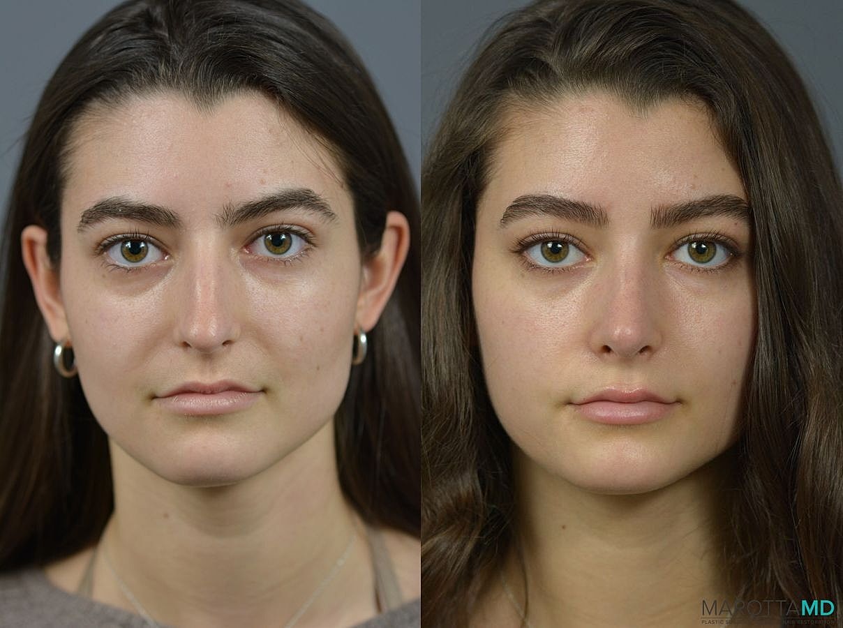 Nose Surgery Before & After
