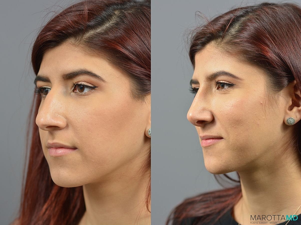 Nose Surgery Before & After