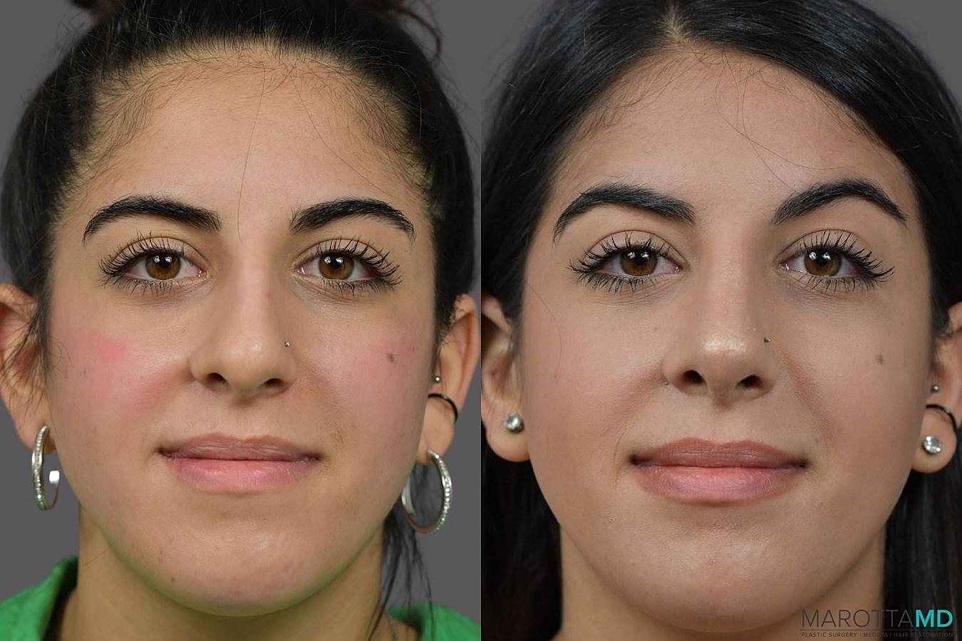 Nose Surgery Before & After