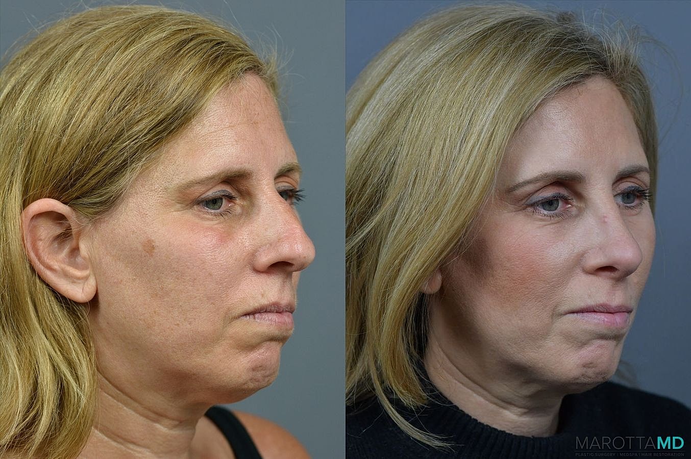 Nose Surgery Before & After