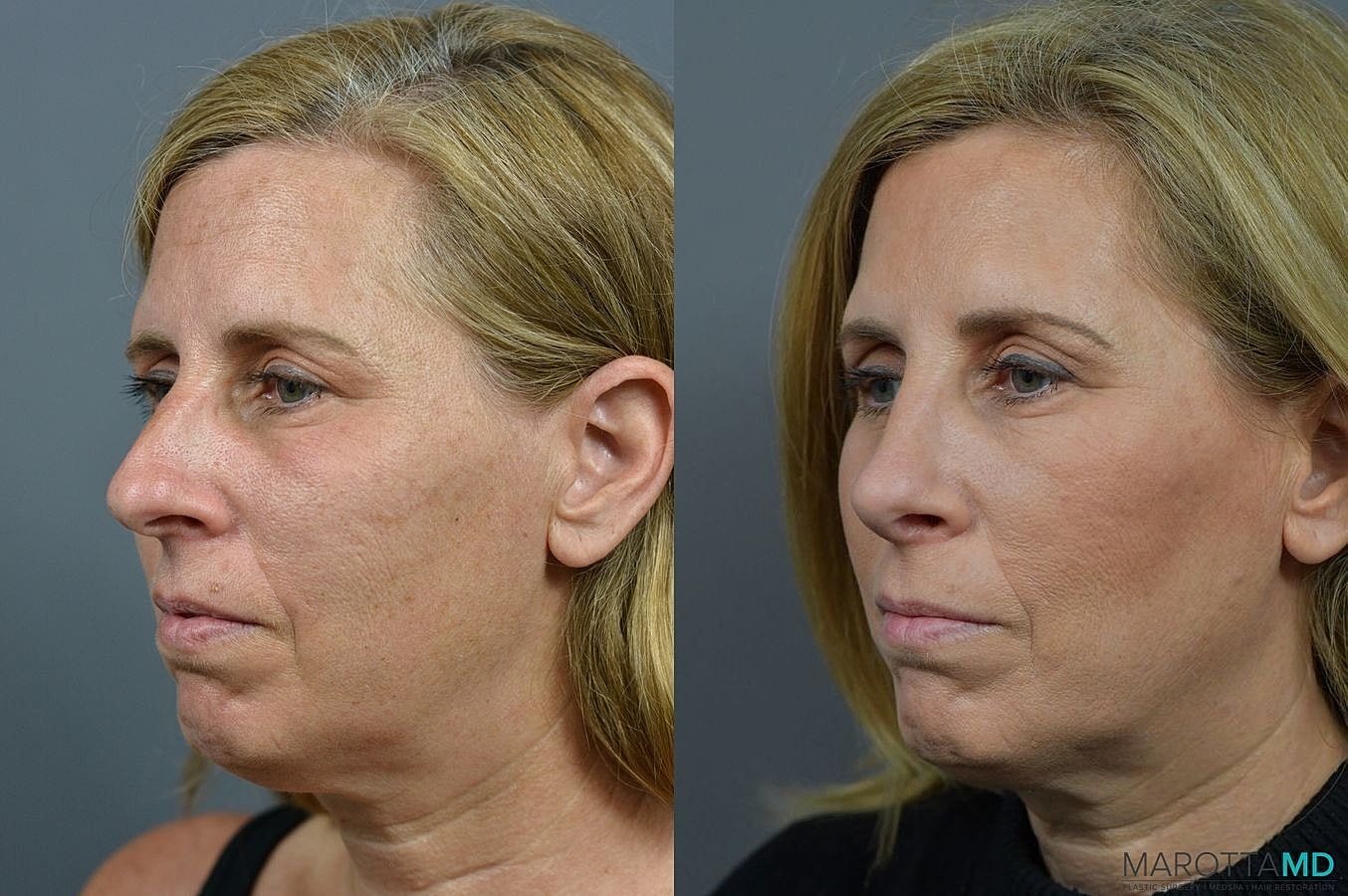 Nose Surgery Before & After