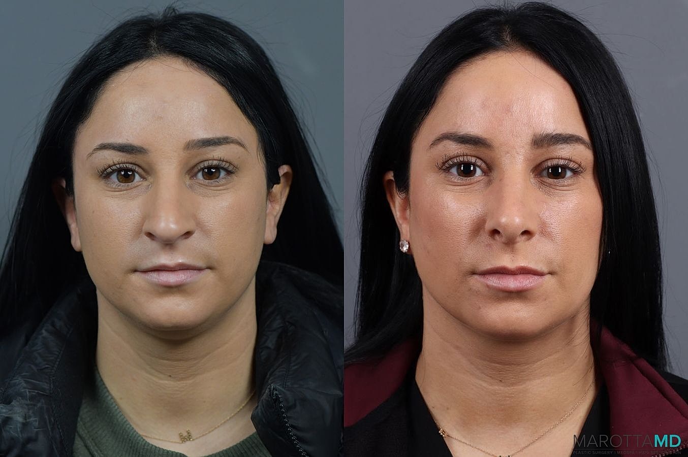 Nose Surgery Before & After