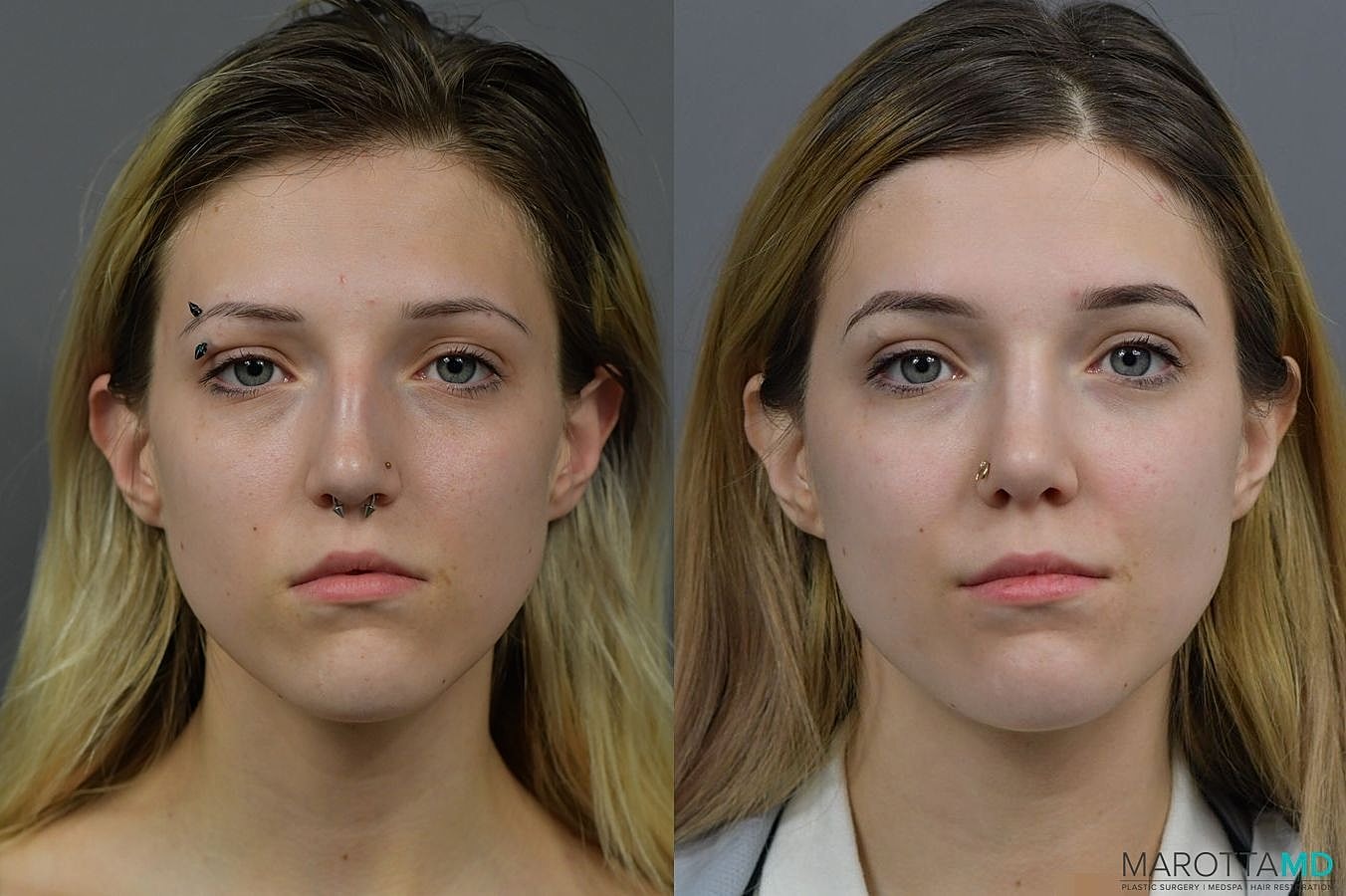 Nose Surgery Before & After
