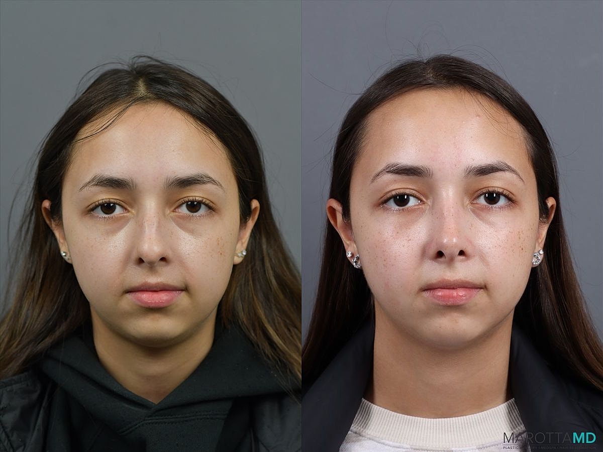 Nose Surgery Before & After