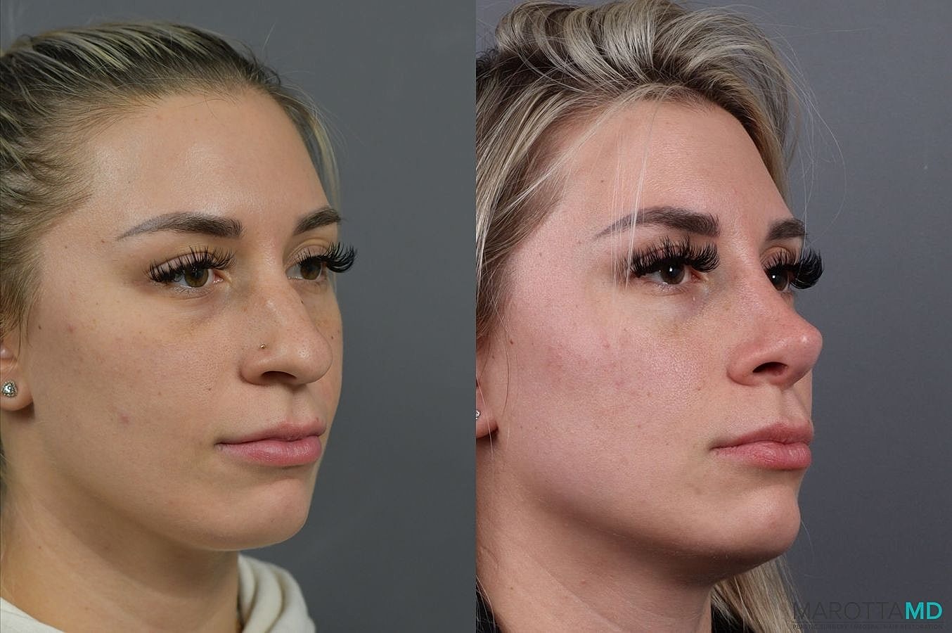 Nose Surgery Before & After