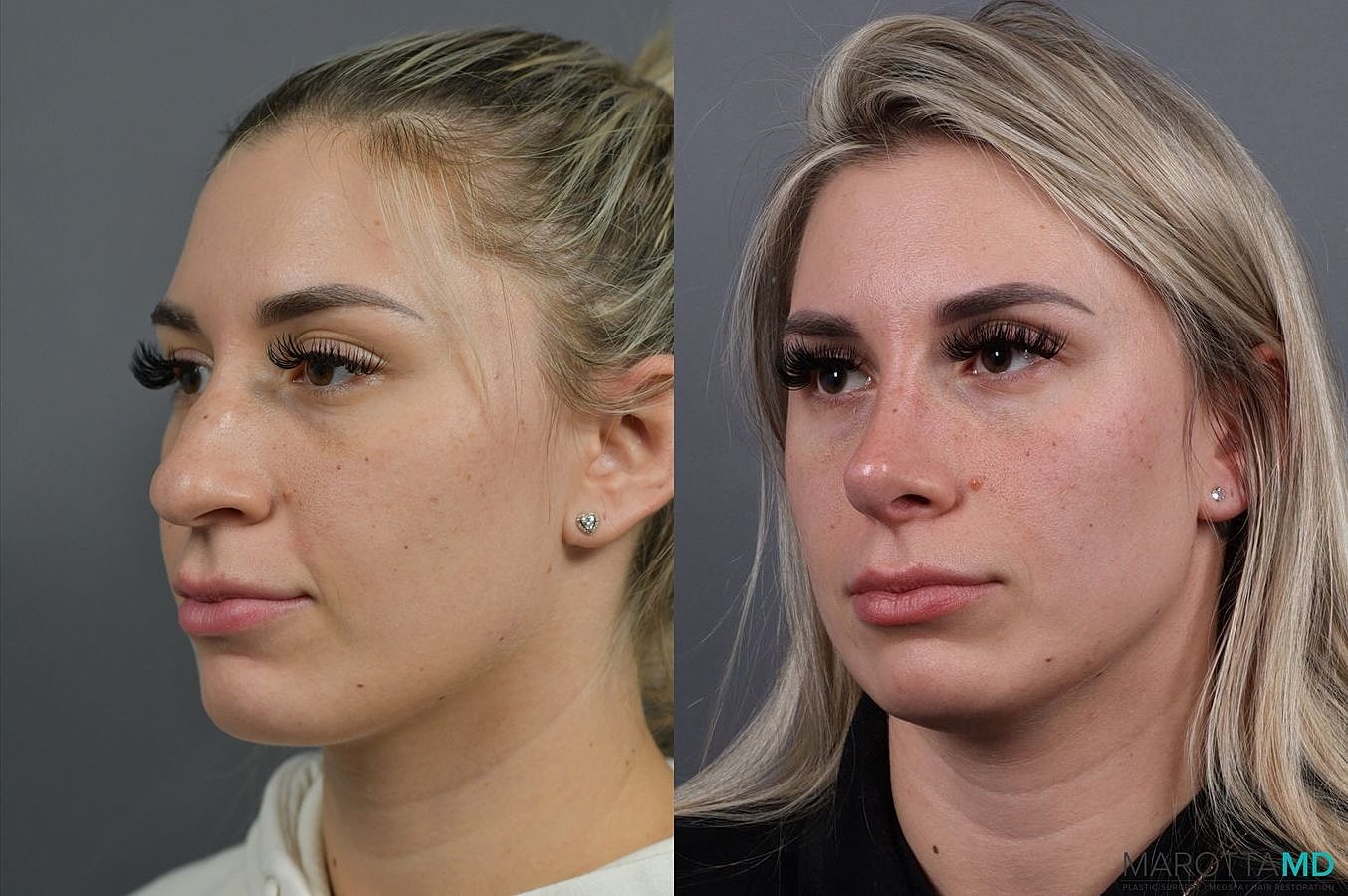 Nose Surgery Before & After