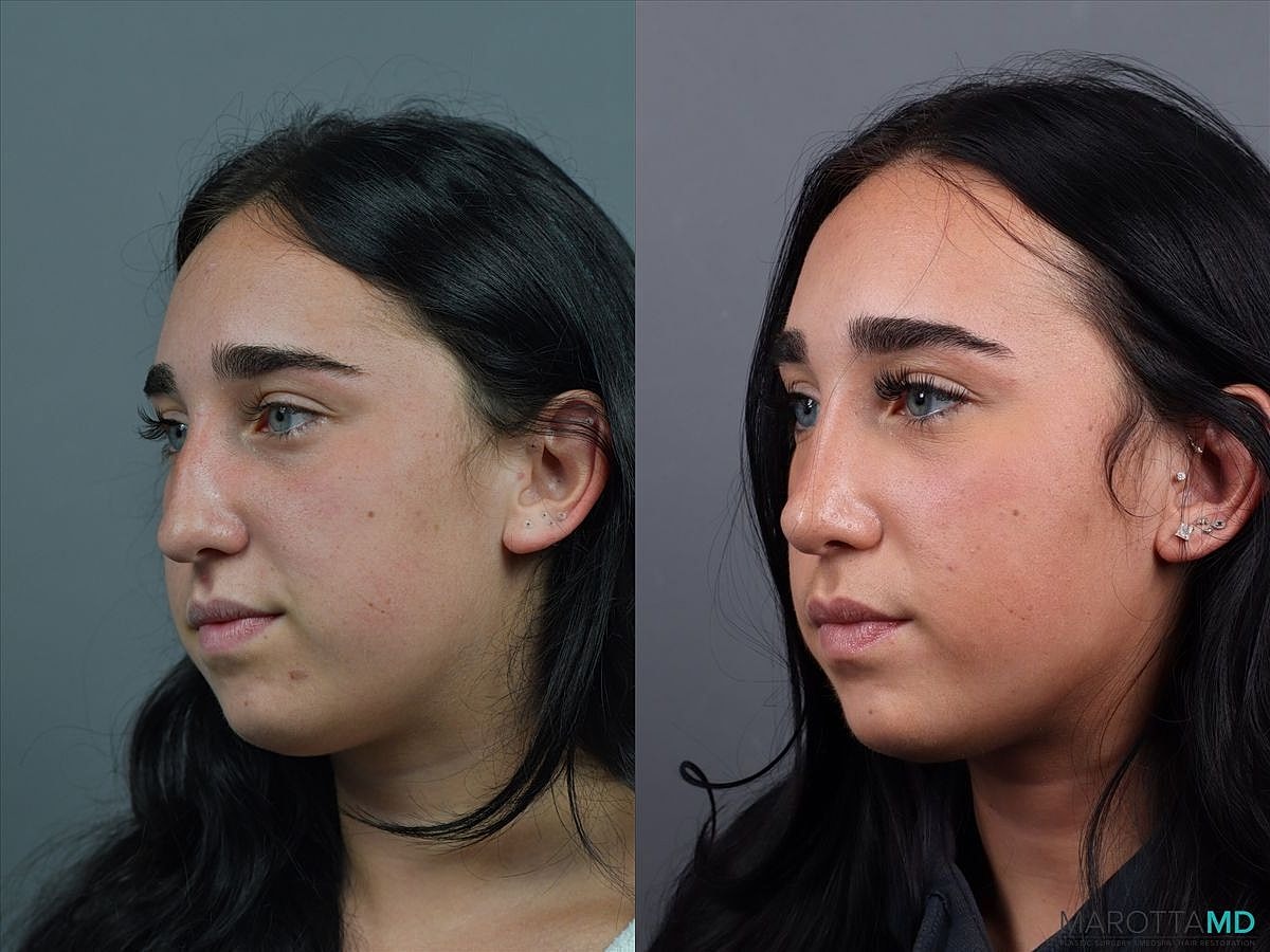 Nose Surgery Before & After