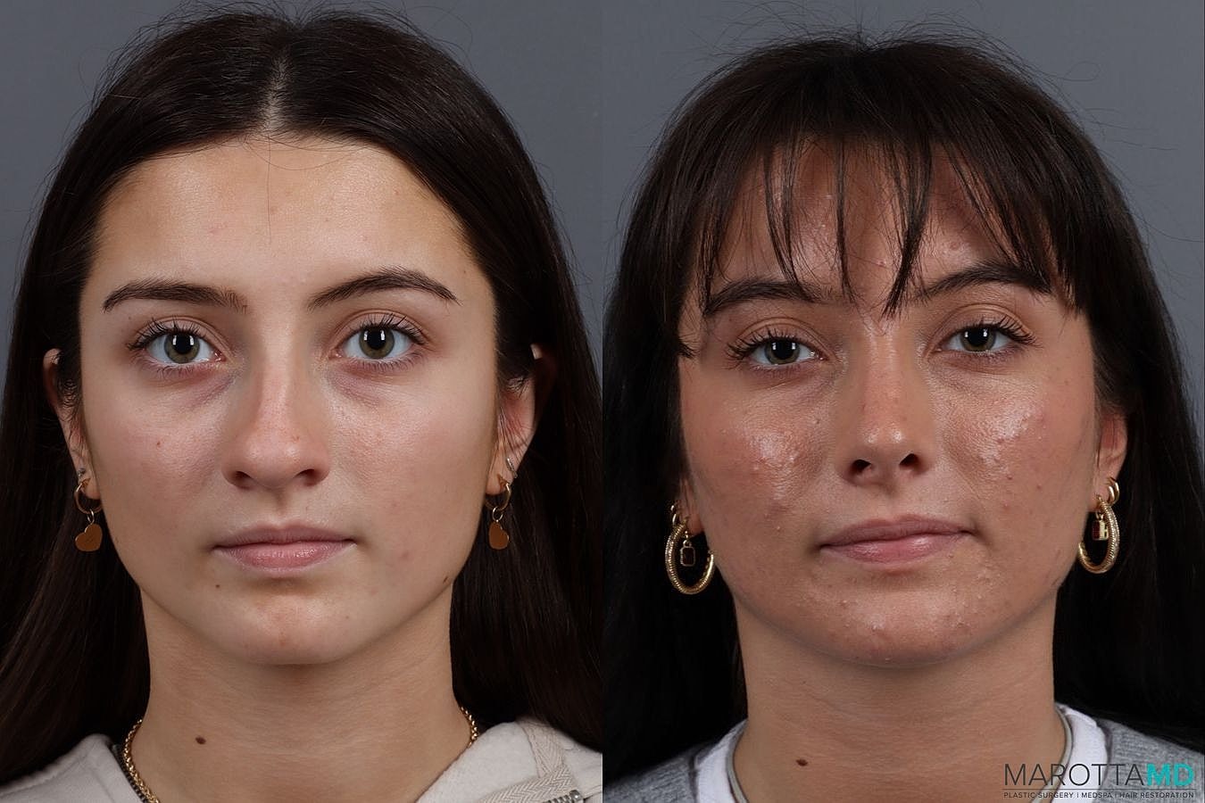 Nose Surgery Before & After