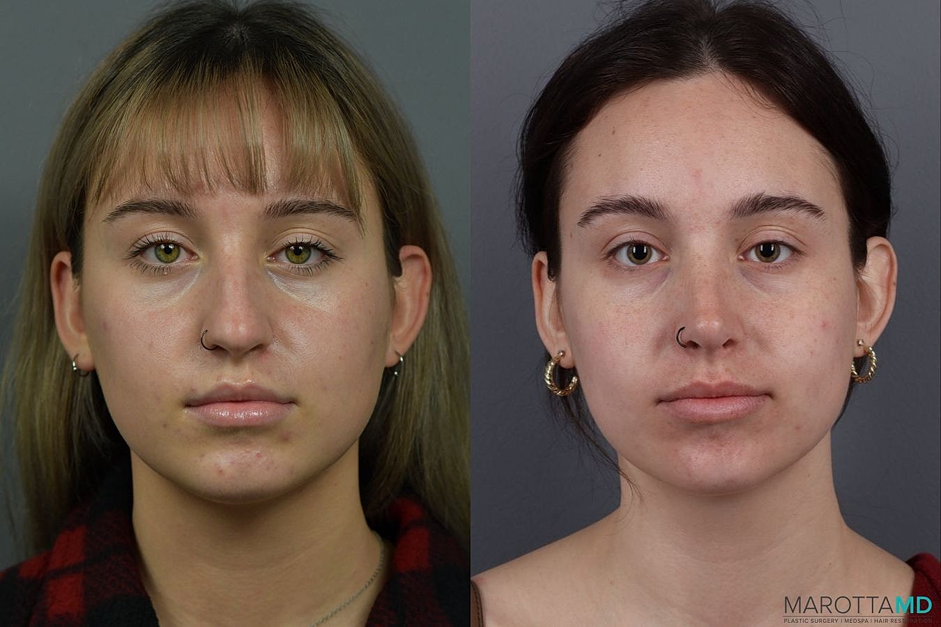 Nose Surgery Before & After