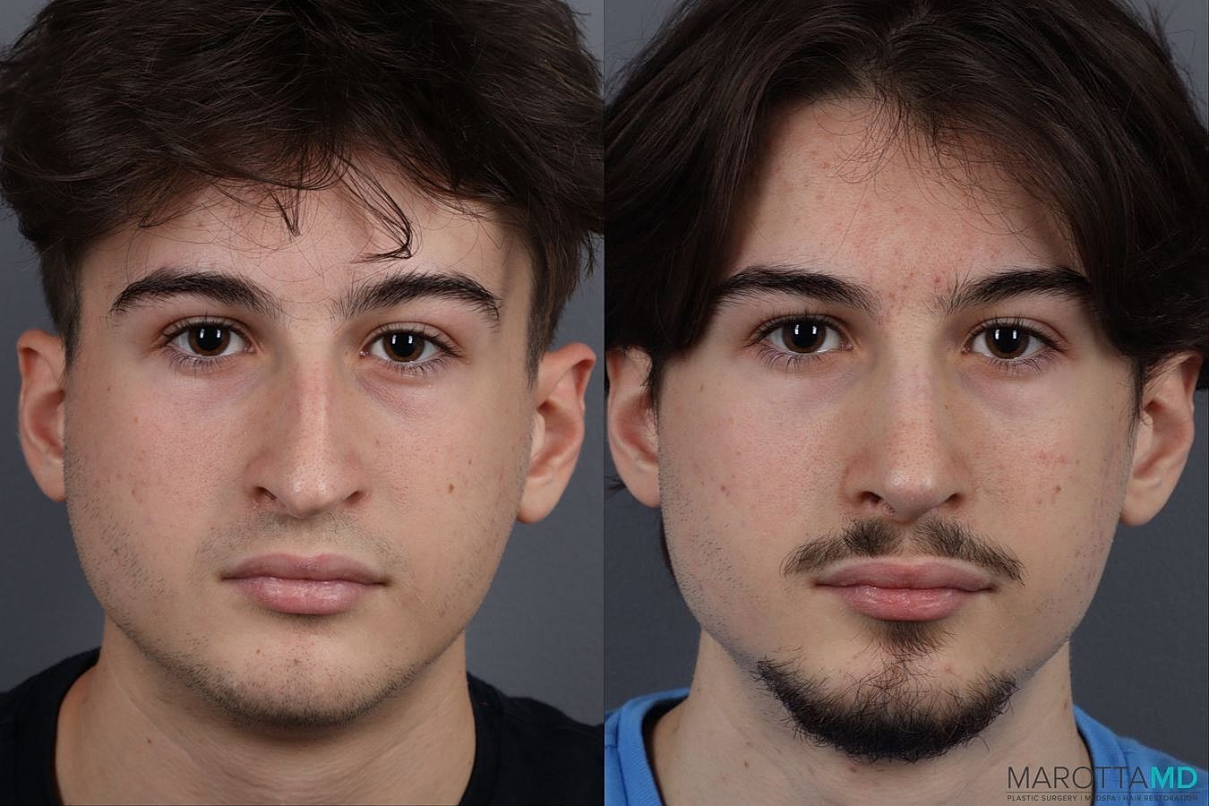 Nose Surgery Before & After