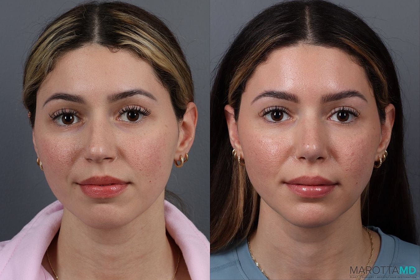 Nose Surgery Before & After