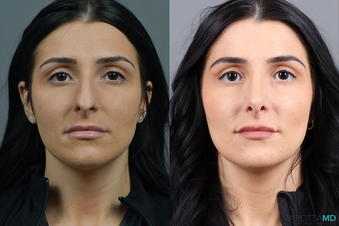 Nose Surgery Before & After