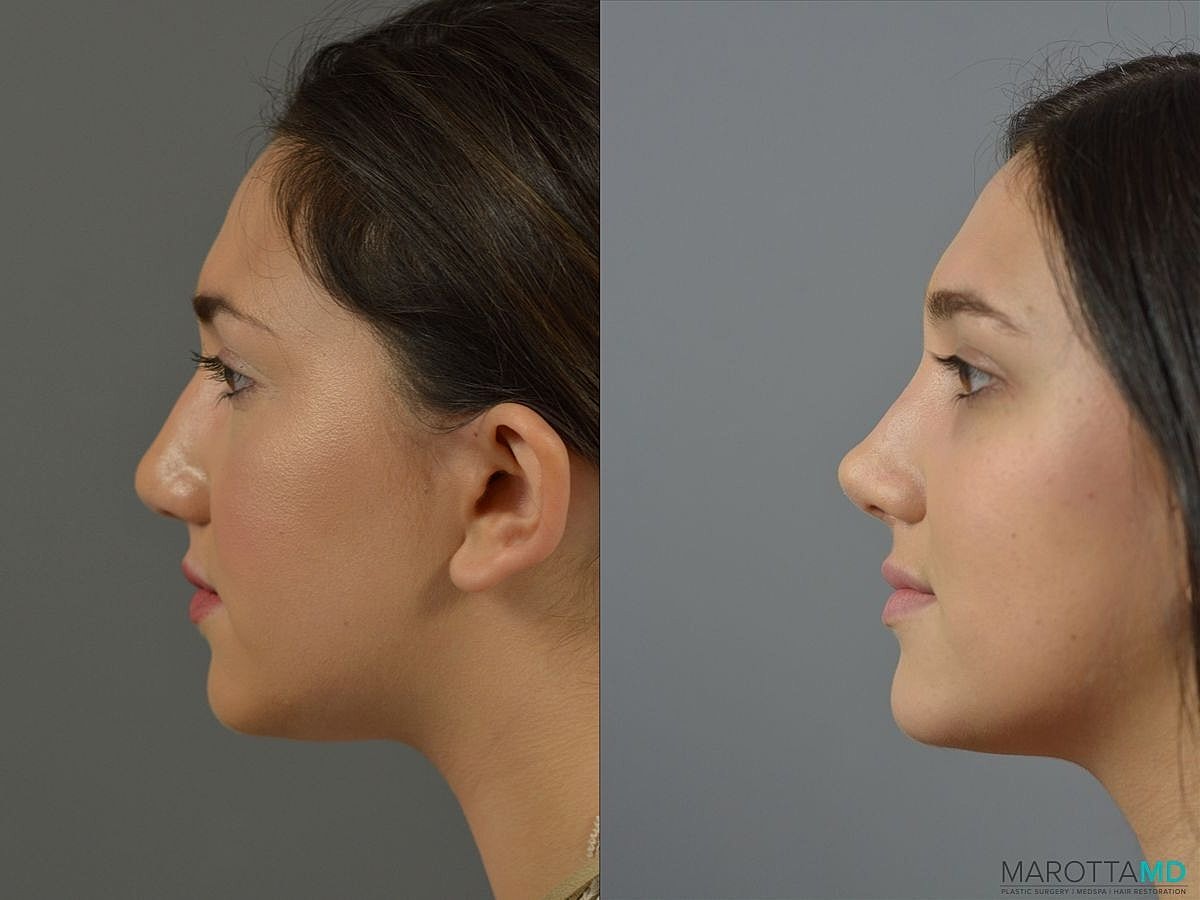 Nose Surgery Before & After