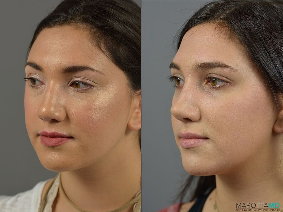 Nose Surgery Before & After