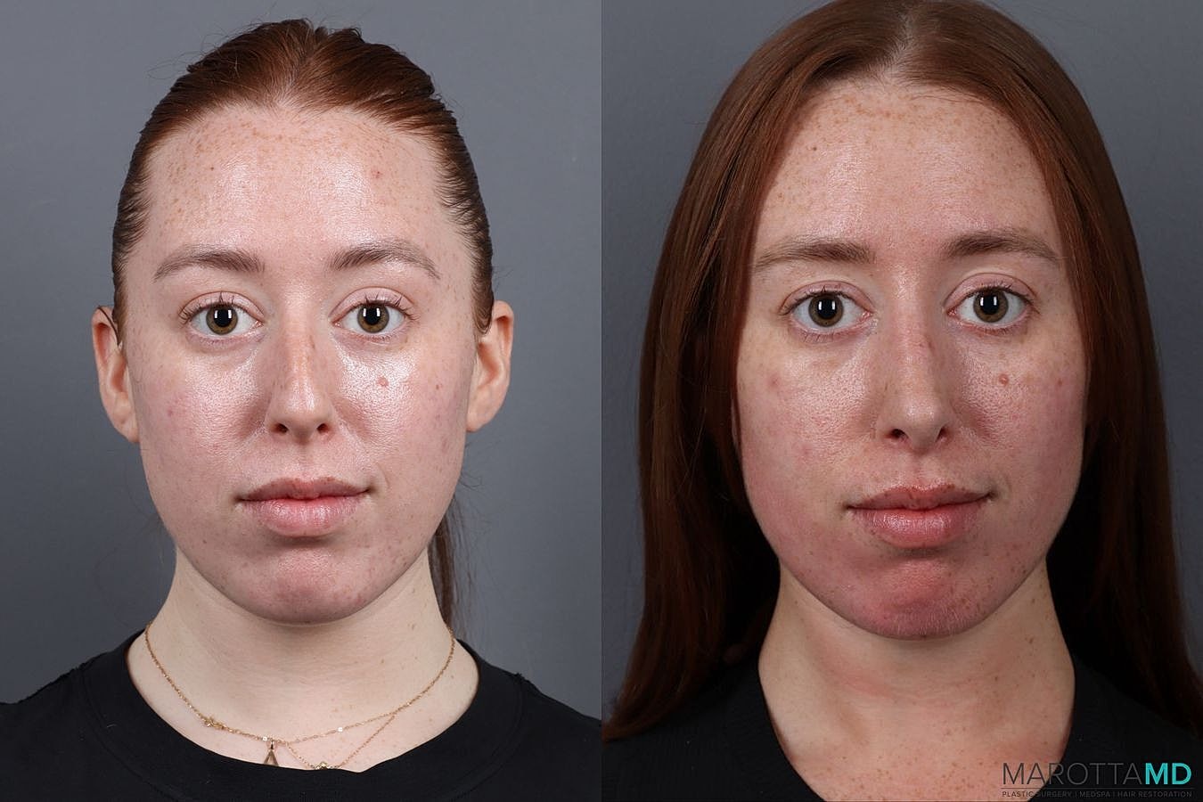 Nose Surgery Before & After