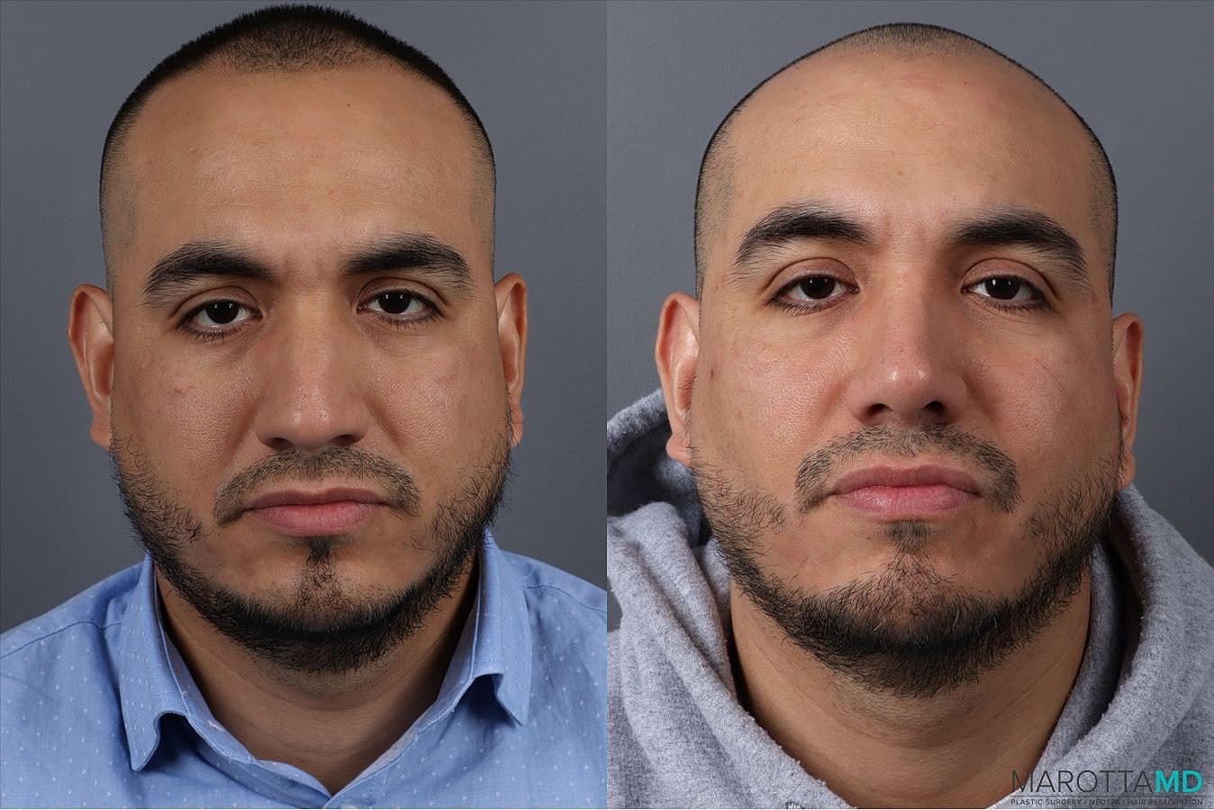 Nose Surgery Before & After