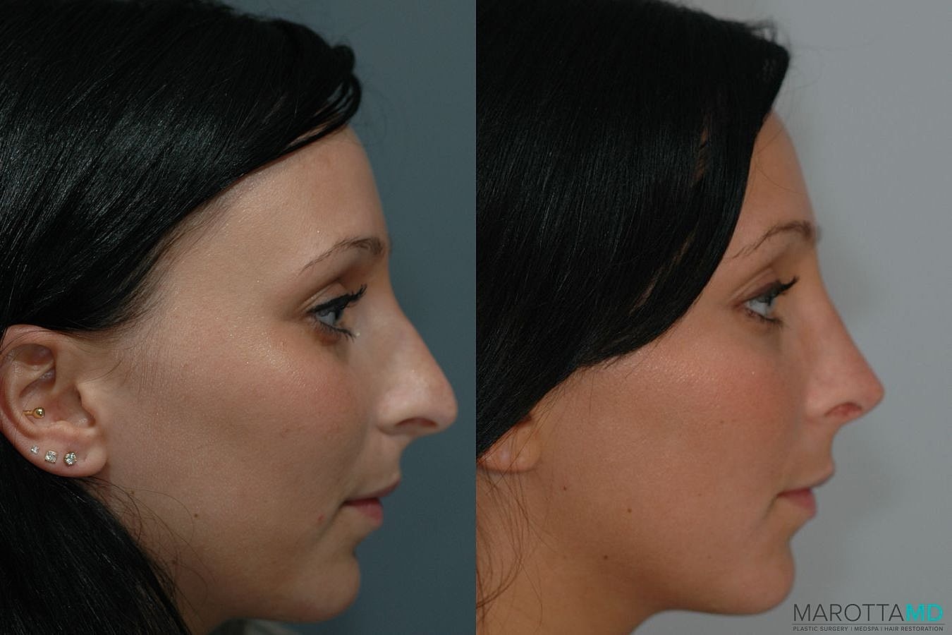 Nose Surgery Before & After