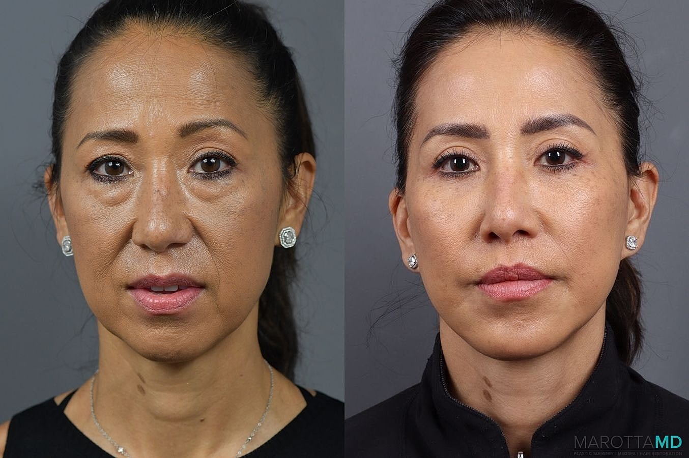 Mini Lift Before & After