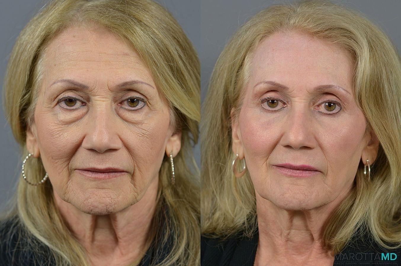 Eyelid Surgery Before & After
