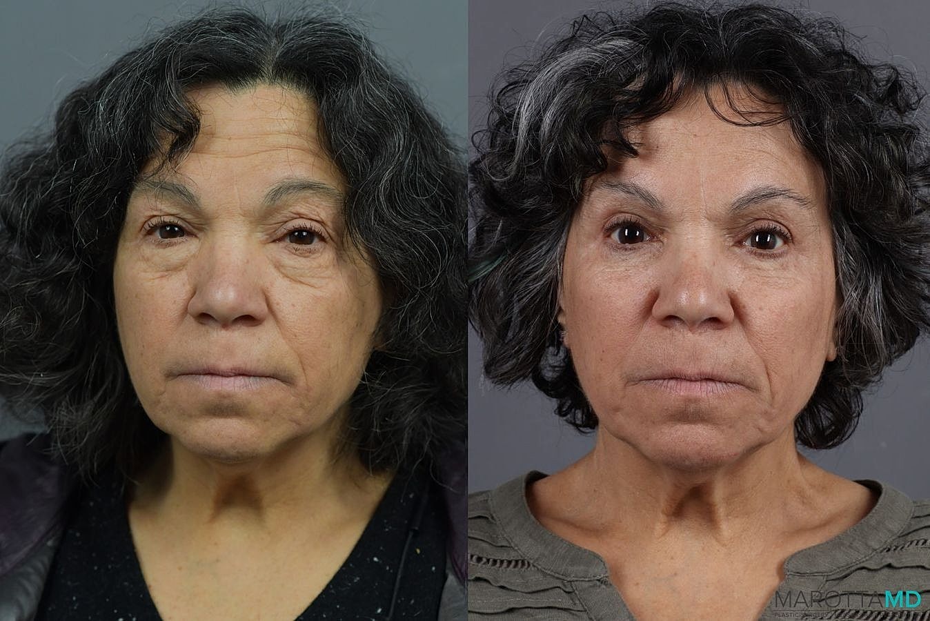 Eyelid Surgery Before & After