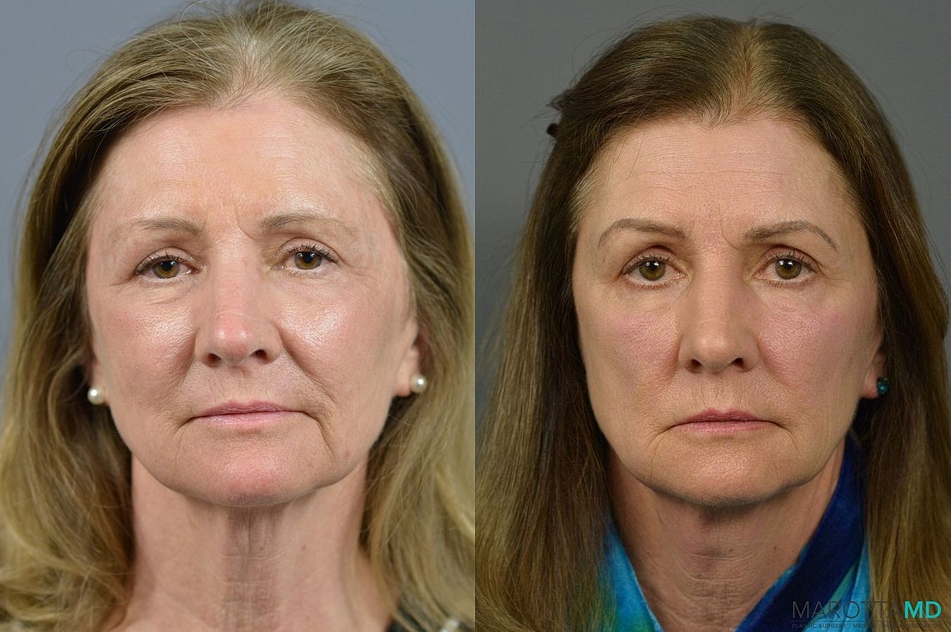 Eyelid Surgery Before & After