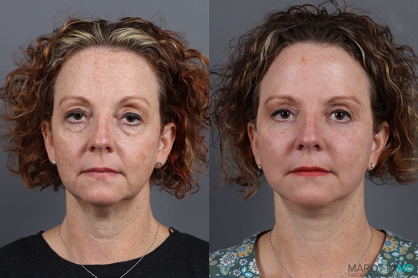 Eyelid Surgery Before & After