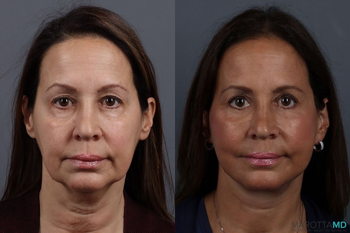 Eyelid Surgery Before & After
