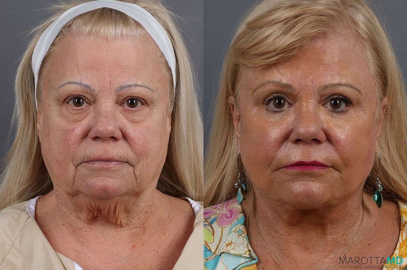 Eyelid Surgery Before & After