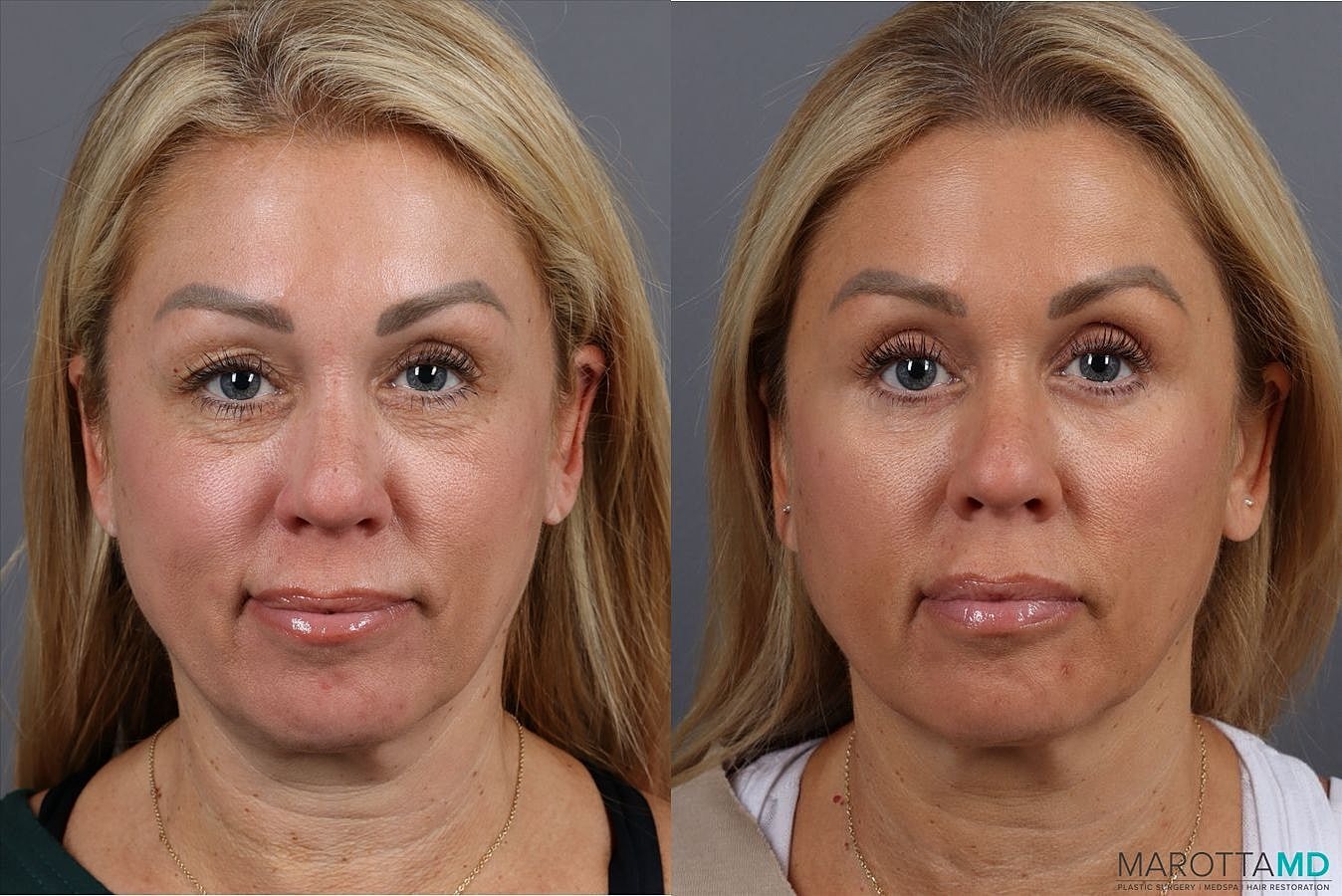 Eyelid Surgery Before & After