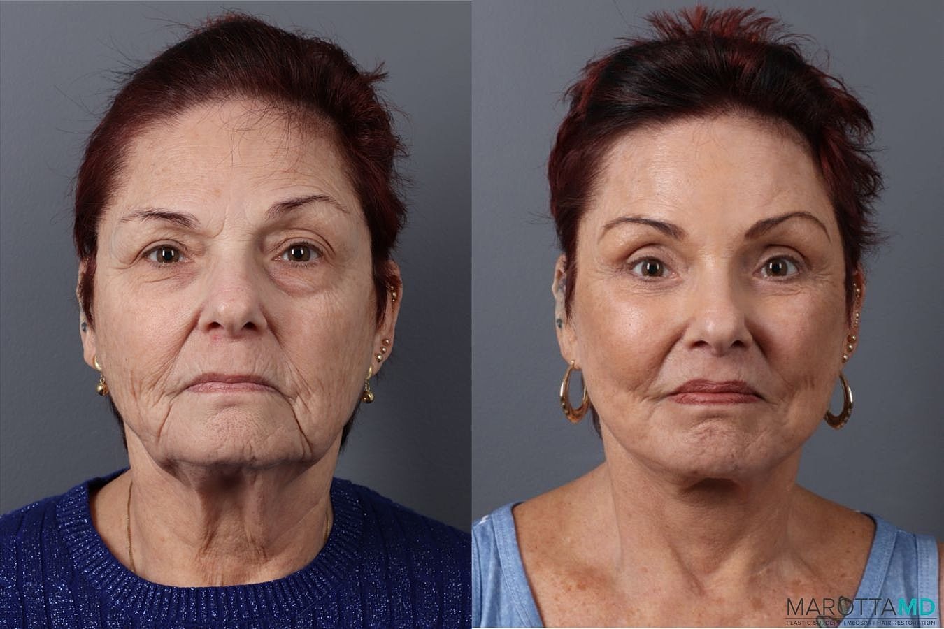 Eyelid Surgery Before & After