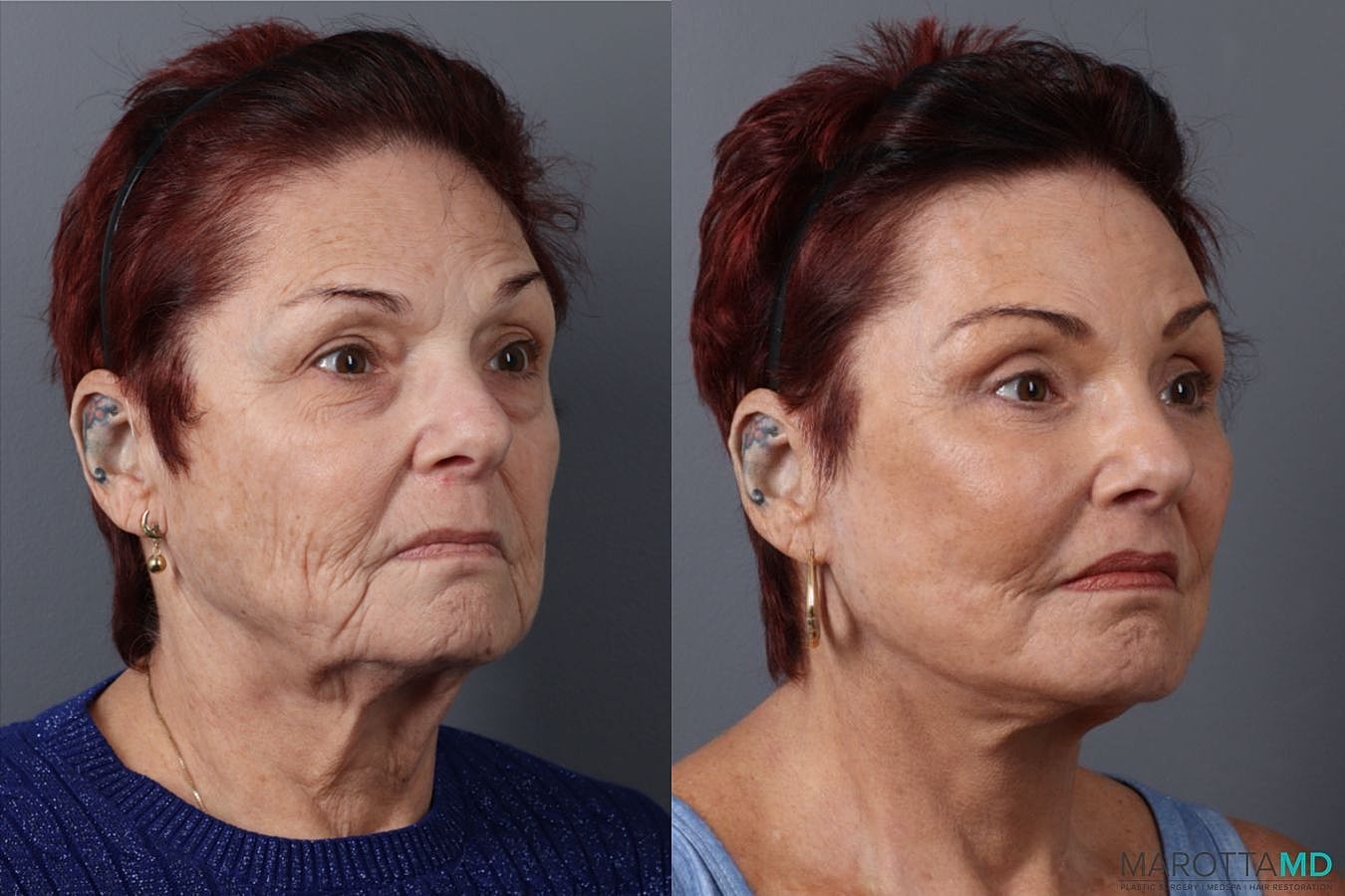 Eyelid Surgery Before & After