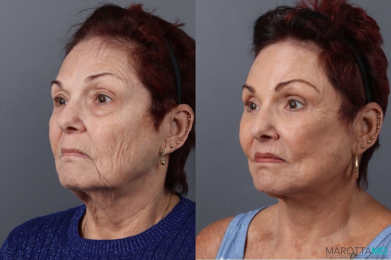Eyelid Surgery Before & After